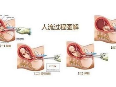 清宫手术演示过程，清宫秘史详细的介绍