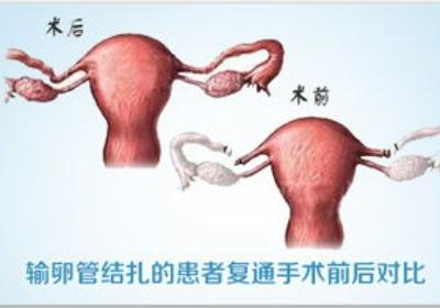 接输卵管手术需要多少钱 输卵管接通价格