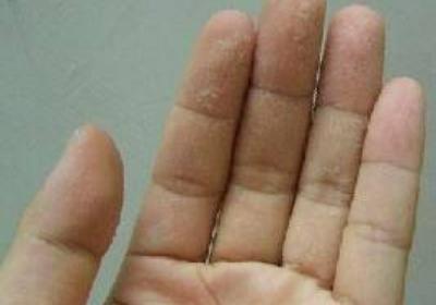 手上有小水泡是怎么回事 小水泡不疼不痒